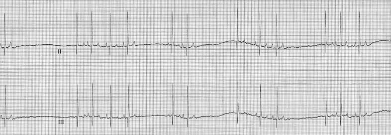ECG recording of leads II and III at 25 mm/sec, taken 25 minutes after 0.04 mg/kg atropine subcutaneously. Shows sinus bradycardia with episodes of sinus arrest and escape beats. The ECG before atropine was not different.