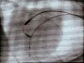 Fluoroscopic image showing the permanent lead withdrawn and readvanced toward the tricuspid valve. The tip is lodged against the valve and bending as force is applied.
