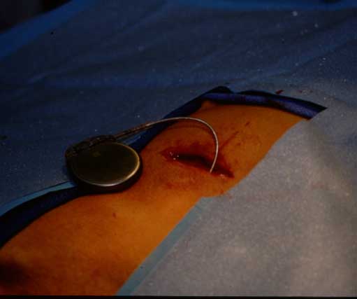 Photograph from another dog showing the pacemaker generator attached to the lead. The lead has been tunneled subcutaneously from the neck (jugular vein) back to the lateral thorax. A skin incision and pocket beneath the cutaneous trunci muscle hold the generator.