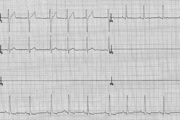 Chest leads. Top left is V1, next down is V2, and top right is V4.