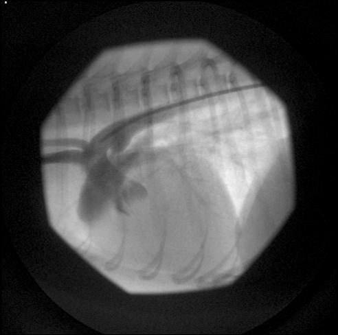 Angiogram showing the PDA location (arrow) between the aorta and main pulmonary artery.