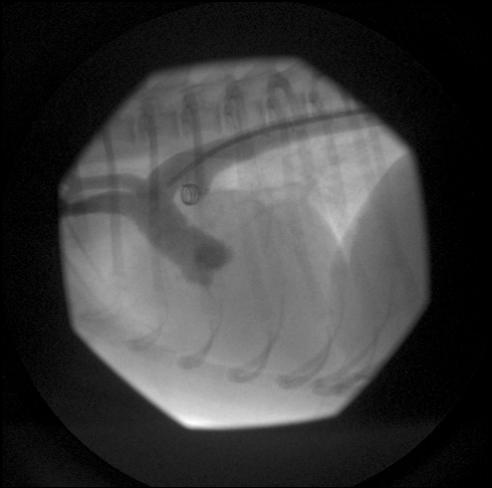Post-procedure angiogram showing coils in the ductus with no contrast in the pulmonary artery.
