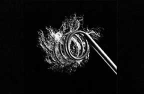 Close-up of a coil being deployed from a catheter.