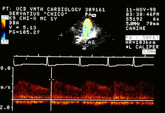 Continuous wave Doppler taken from the center of the color flow jet. Peak velocity in systole is 5.13 m/s (PG = 105 mmHg). Flow occurs throughout systole and diastole, characteristic of a left-to-right shunting PDA.