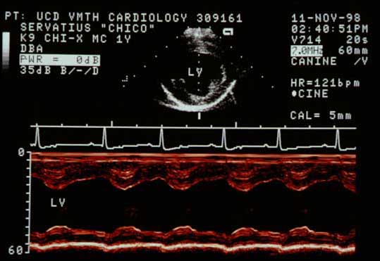 M-mode echocardiogram across the center of the left ventricle (LV) with breath held. LV diastolic diameter is increased to 3.3 cm (normal 2.5 cm). End-systolic diameter is also increased to 2.2 cm (normal 1.5 cm). Shortening fraction is normal at 33%.