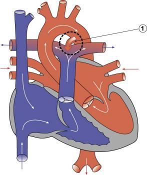Schematic drawing of a patent ductus arteriosus showing the funnel-shaped connection between the aorta and main pulmonary artery.