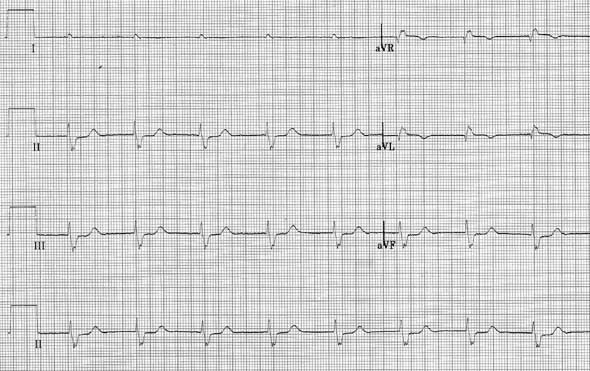ECG at 50 mm/sec, 1 cm = 1 mV. No P waves. Rate ~120 bpm. Regular rhythm. Terminal left axis deviation. Consistent with atrial standstill.