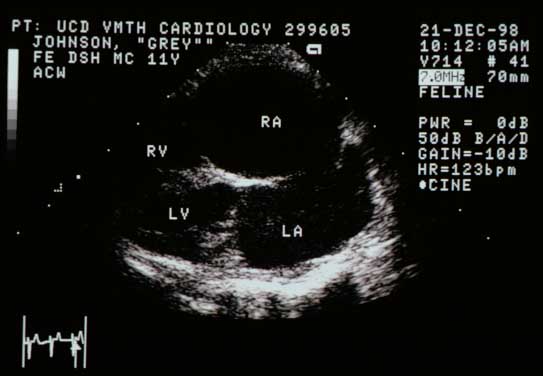 Right parasternal long-axis echocardiogram showing massively enlarged left atrium (LA) and right atrium (RA) with relatively normal-appearing ventricles. RV — right ventricle; LV — left ventricle.
