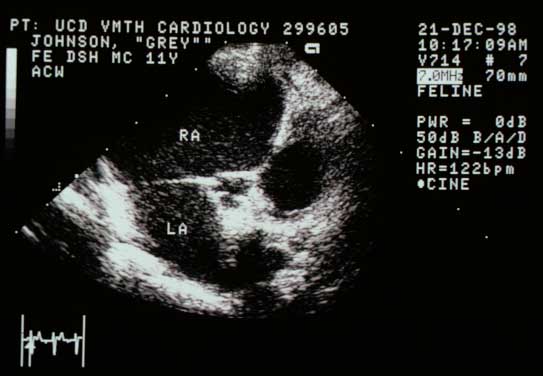 Right parasternal short-axis basilar view with the aorta in the middle, the left atrium (LA) below and to the left, and the right atrium (RA) above. Both atria are massively enlarged.