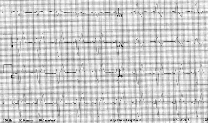 Six limb lead ECG with leads I, II, III simultaneously on the left and aVR, aVL, aVF on the right. Lead II continuous along the bottom. QRS complexes are wide with each preceded by a P wave. Terminal forces point cranially and to the right.