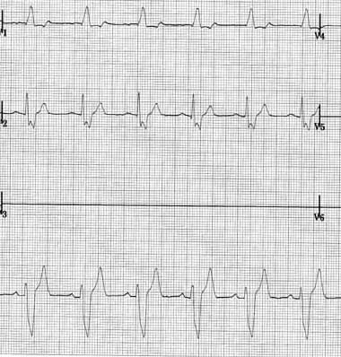 Chest leads V1 and V2 along with lead II at the bottom, confirming the right bundle branch block pattern.