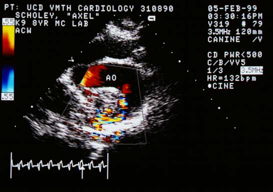 Color flow Doppler showing a pulmonary artery below the aorta (AO), almost totally occluded by the structure. Flow around the structure is markedly reduced and turbulent.