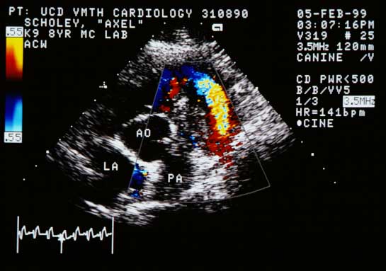Color flow Doppler in systole showing a larger turbulent flow pattern in the right ventricular outflow tract, probably large enough to explain the heart murmur heard on physical examination.