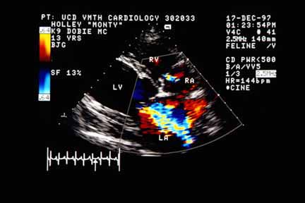 Color flow Doppler echocardiogram in systole (ECG cursor between QRS and T wave) showing a high-velocity, turbulent mitral regurgitation jet originating at the mitral valve and extending centrally into the left atrium