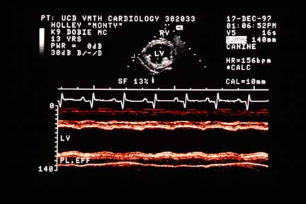 M-mode echocardiogram showing normal left ventricular wall thicknesses, enlarged end-diastolic diameter of 6 cm (normal ~4.5 cm), enlarged end-systolic diameter of 5.2 cm (normal ~3 cm), and pleural effusion (PL. EFF) visible posterior to the left ventricular wall