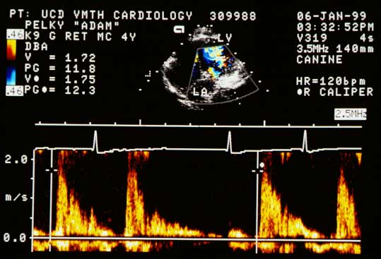 Pulsed wave Doppler tracing with cursor immediately distal to the mitral valve. Flow is toward the transducer (above the line) in diastole. Peak early diastolic velocity is 1.75 m/s (PG ~12 mmHg). A peak of 2 m/s (PG 16 mmHg) was recorded at another time.