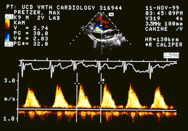 Continuous wave Doppler echocardiogram with the cursor placed through the color jet in the right atrium, showing the tricuspid regurgitation velocity.