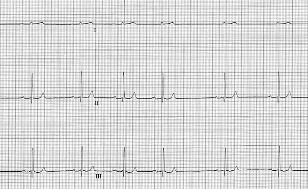 ECG after pericardiocentesis showing resolution of electrical alternans, larger QRS complexes, and sinus arrhythmia.