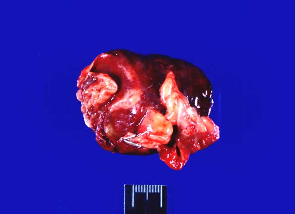 Excised right auricle mass consistent with hemangiosarcoma.