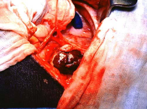Intraoperative photograph showing a large hemangiosarcoma mass involving the right auricle.