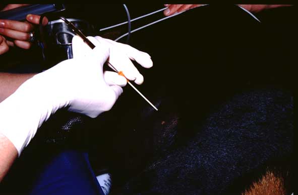 Pericardiocentesis being performed with the catheter advanced into the pericardial space.