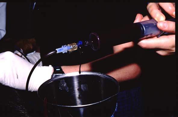 Approximately 900 ml of hemorrhagic pericardial fluid removed during pericardiocentesis.