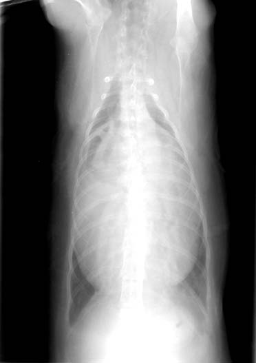 Dorsoventral thoracic radiograph showing an enlarged cardiac silhouette with heterogeneous density including gas-filled structures.