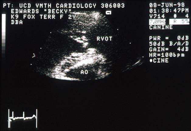 Right parasternal echocardiogram of a Fox Terrier showing a fibrous lesion between the body of the right ventricle and the right ventricular outflow tract, similar to Tiffany's but more fibrous in appearance.