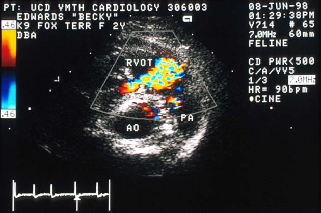 Color flow Doppler echocardiogram showing turbulent flow through the obstruction into the right ventricular outflow tract. PA = main pulmonary artery; AO = aorta.