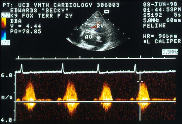 Continuous wave Doppler echocardiogram showing underestimated velocity and pressure gradient due to non-parallel beam alignment, but still placing the lesion in the severe category.