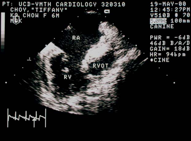 Transesophageal echocardiogram in diastole showing a clear ridge of tissue between the right ventricle (RV) and the right ventricular outflow tract (RVOT) producing an obstruction to blood flow. The right atrium (RA) is severely enlarged with spontaneous contrast visible.