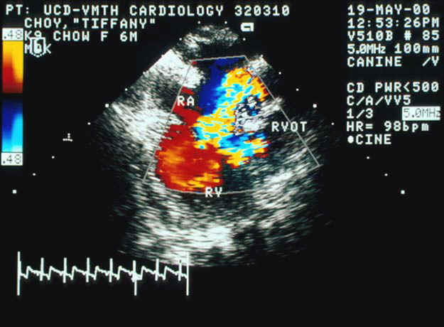 Color flow Doppler transesophageal echocardiogram demonstrating turbulent flow from the right ventricle into the right atrium (tricuspid regurgitation) and into the right ventricular outflow tract (obstruction).