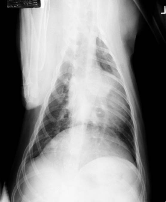Ventrodorsal thoracic radiograph showing a prominent main pulmonary artery bulge and an enlarged right caudal lobar pulmonary artery.