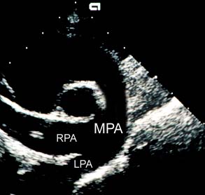Right parasternal short-axis basilar echocardiogram showing the main, left, and right pulmonary arteries. An abnormality (heartworm) can be visualized in the right pulmonary artery as two white lines divided by a dark line.