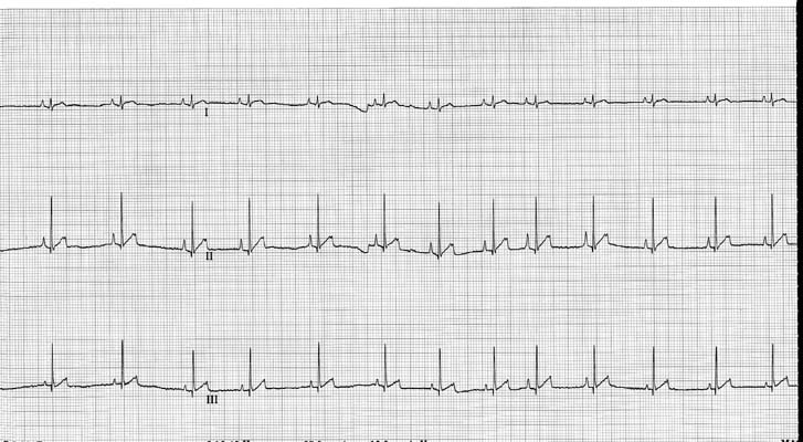 ECG before digital pressure was applied to the pulsatile swelling, showing normal heart rate.
