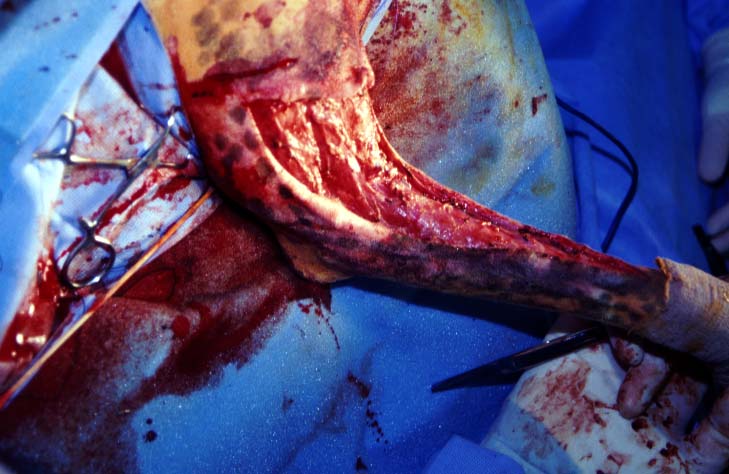 The surgical site after complete removal of the arteriovenous fistula.