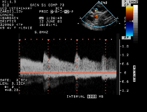 Pulsed wave Doppler echocardiogram of the lesion showing continuous blood flow, consistent with an arteriovenous fistula.