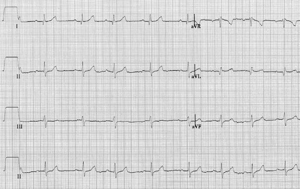ECG showing simultaneous recordings of the six limb leads demonstrating sinus rhythm with an abnormal terminal QRS vector directed cranially, evidenced by S waves in leads II, III, and aVF