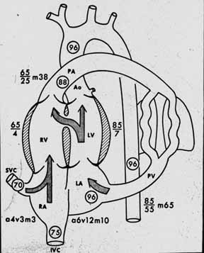 Schematic diagram of a large ventricular septal defect showing blood flow arrows, oxygen saturation percentages in circles, and blood pressures (systolic over diastolic) for each cardiac chamber. Pulmonary vasculature is distended indicating overcirculation, with pulmonary blood flow approximately 3 times systemic blood flow. Right ventricular pressure is shown as 65/4 mmHg reflecting pulmonary hypertension from increased flow.