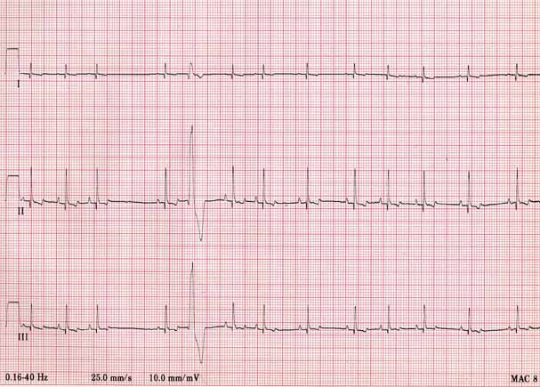 ECG tracing from Max showing sinus complexes with a single premature ventricular complex.
