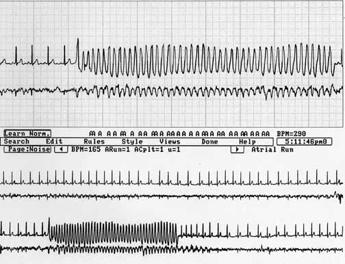Holter monitor strip from Max showing a run of ventricular tachycardia.
