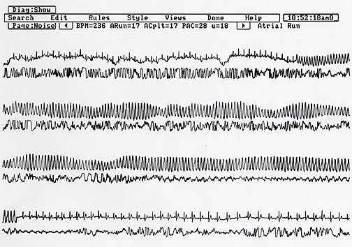 Holter monitor strip from Max showing polymorphic ventricular tachycardia.