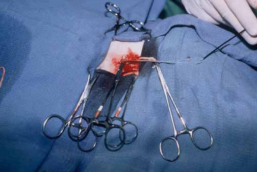 First heartworm being removed from Boris via jugular venotomy.