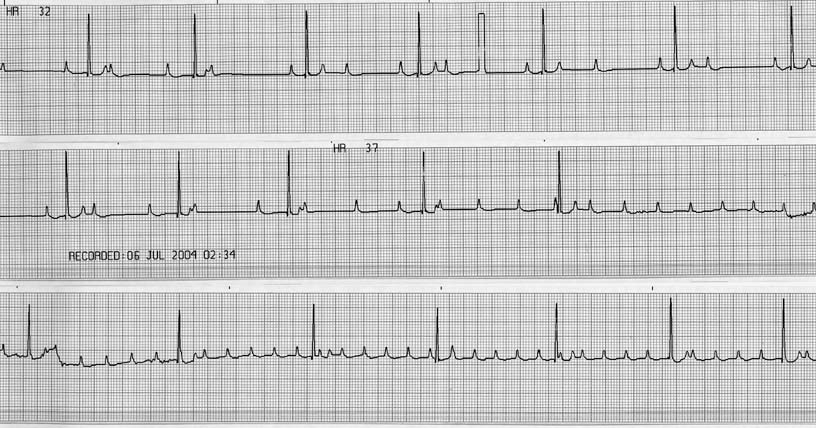 Event monitor ECG recording at 25 mm/sec showing high grade second degree AV block progressing to third degree AV block with a 4-second period of no ventricular activity.