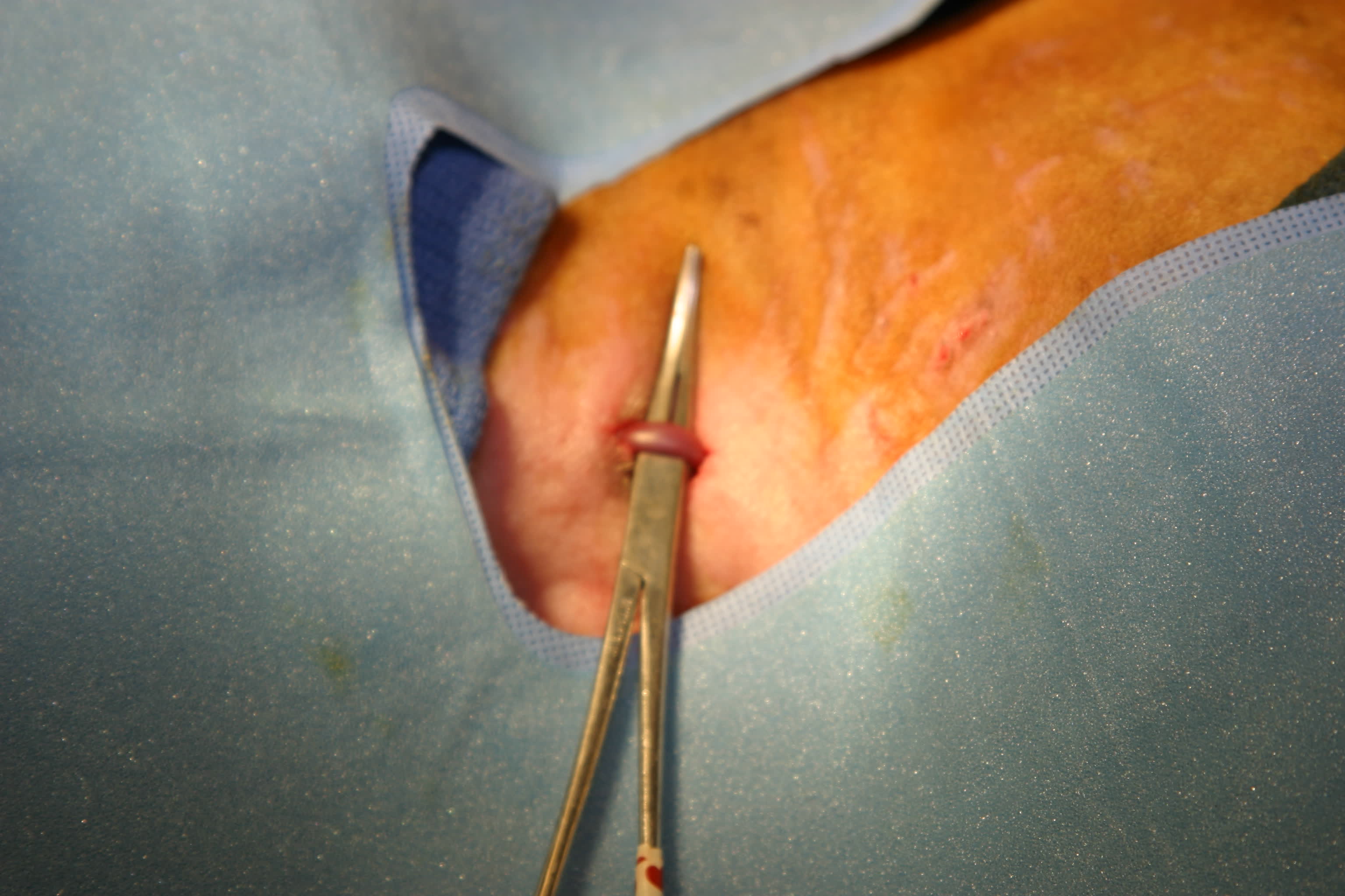 Pacemaker implantation image 1