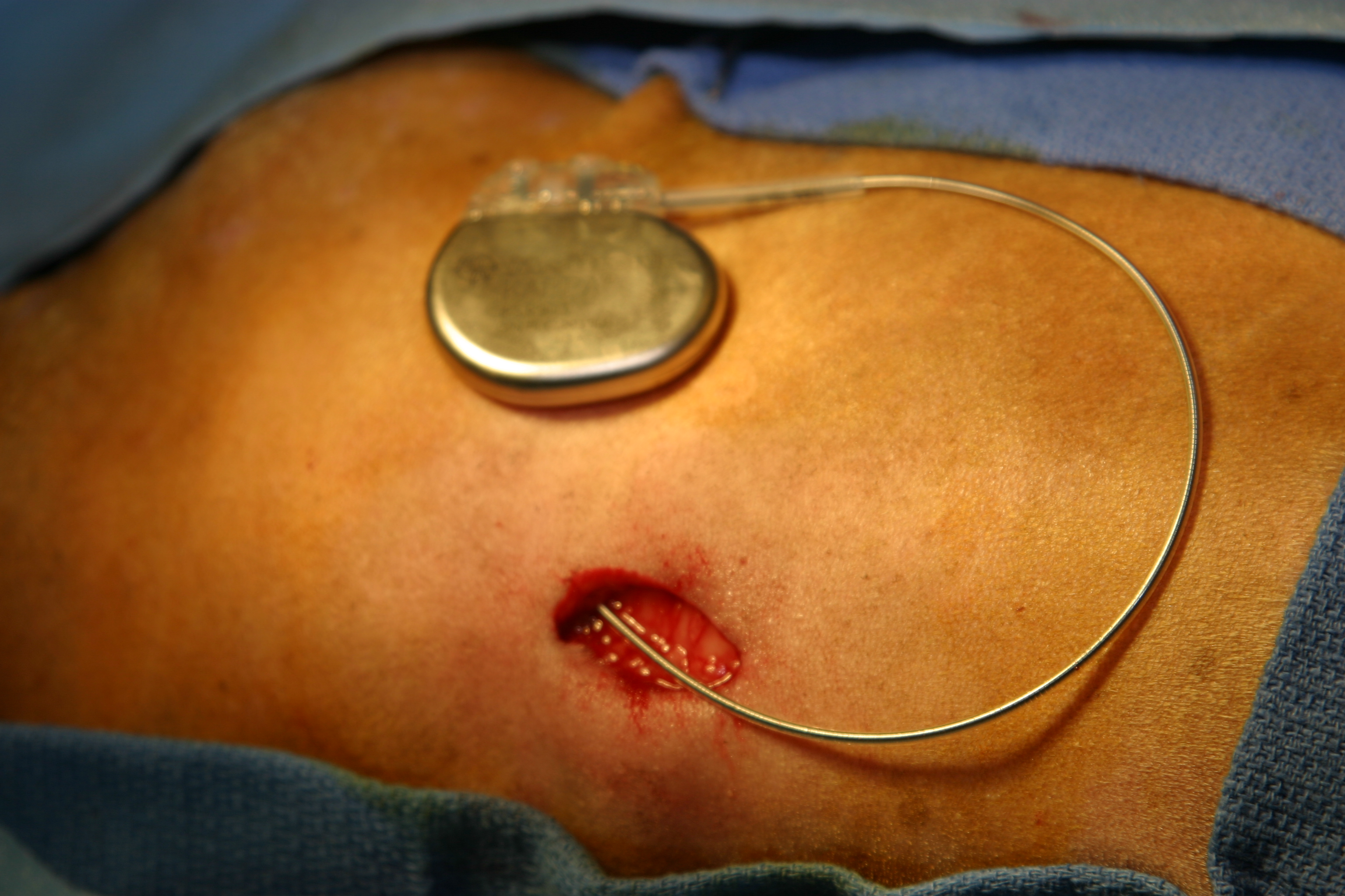 Pacemaker implantation image 10