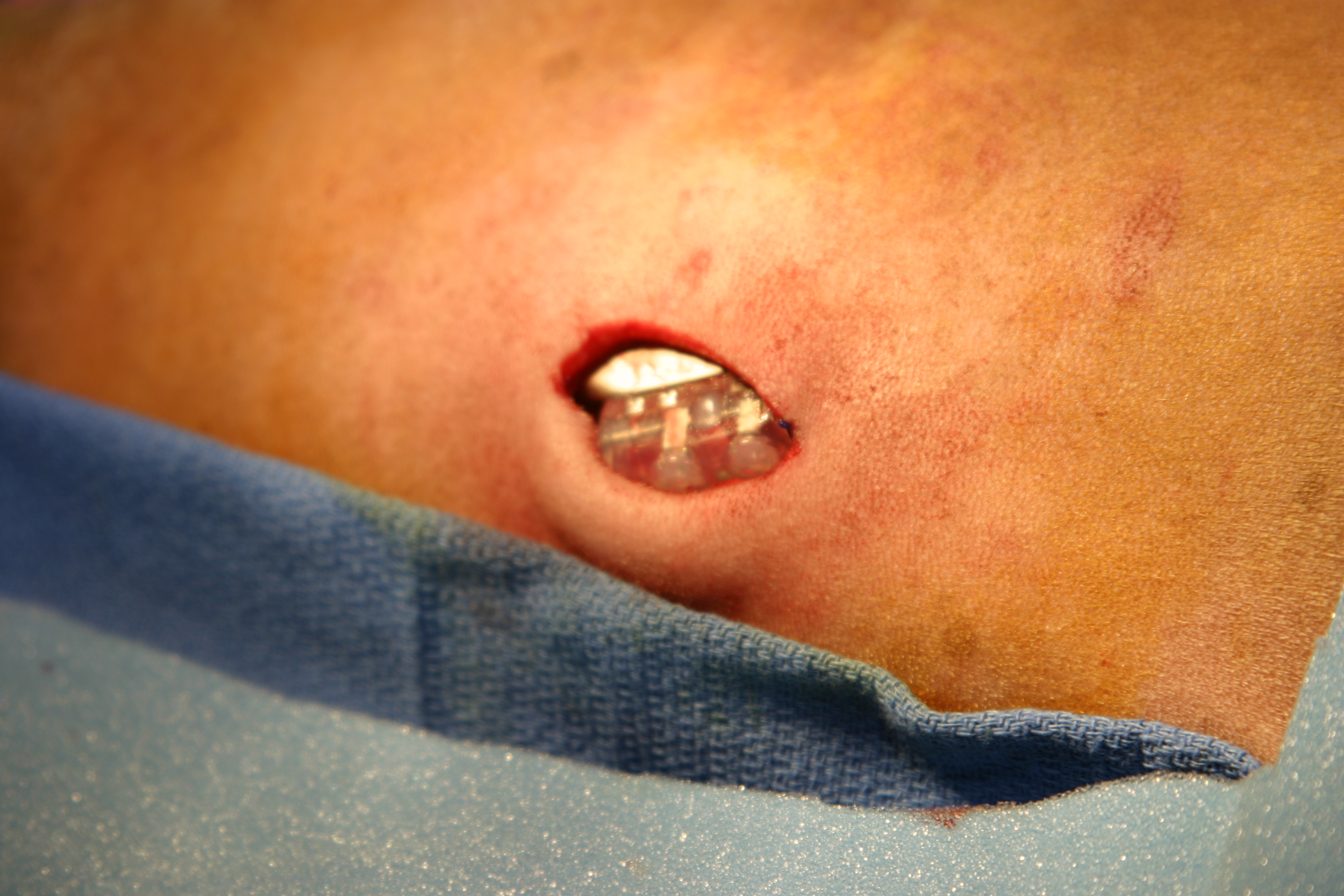 Pacemaker implantation image 11