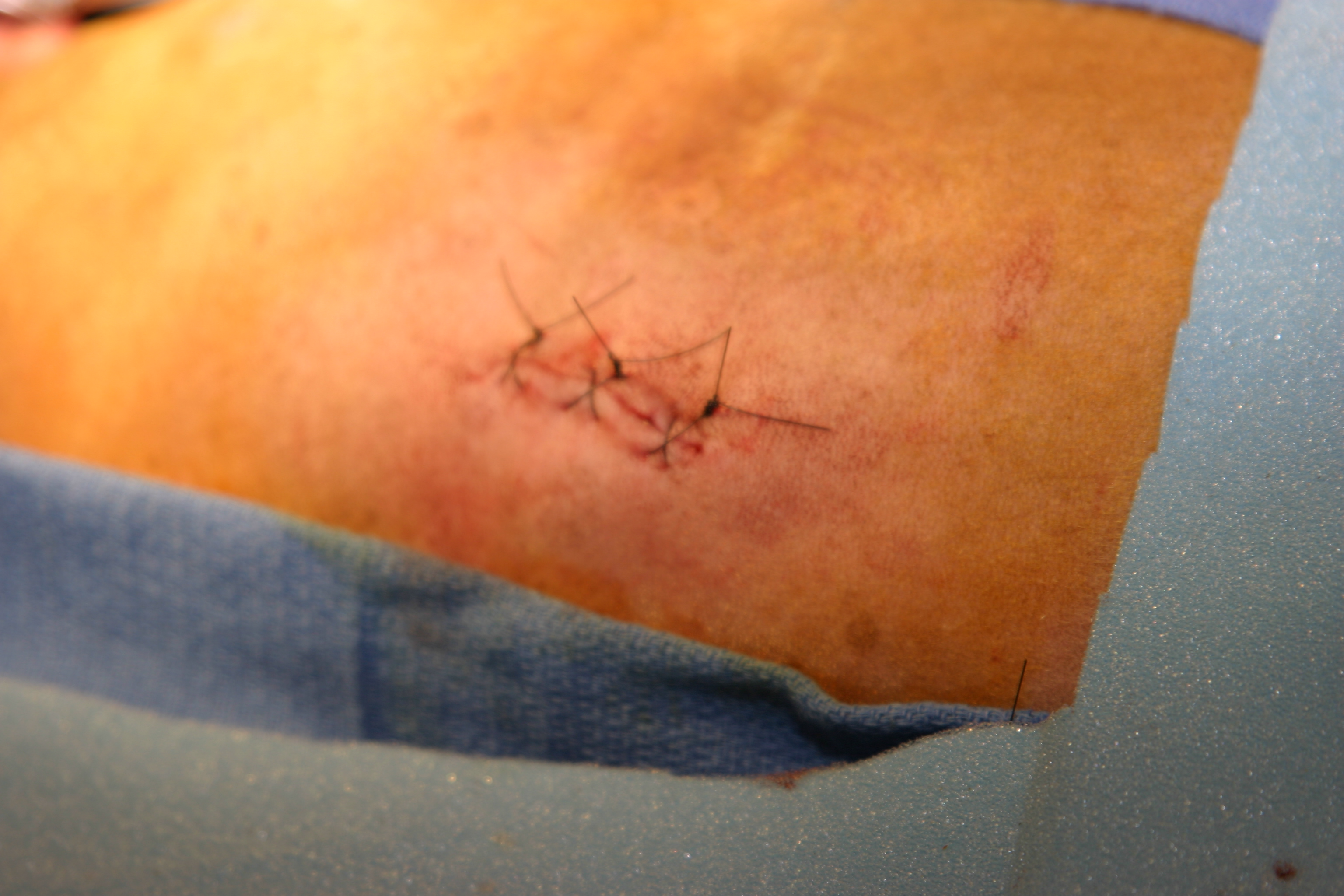 Pacemaker implantation image 12