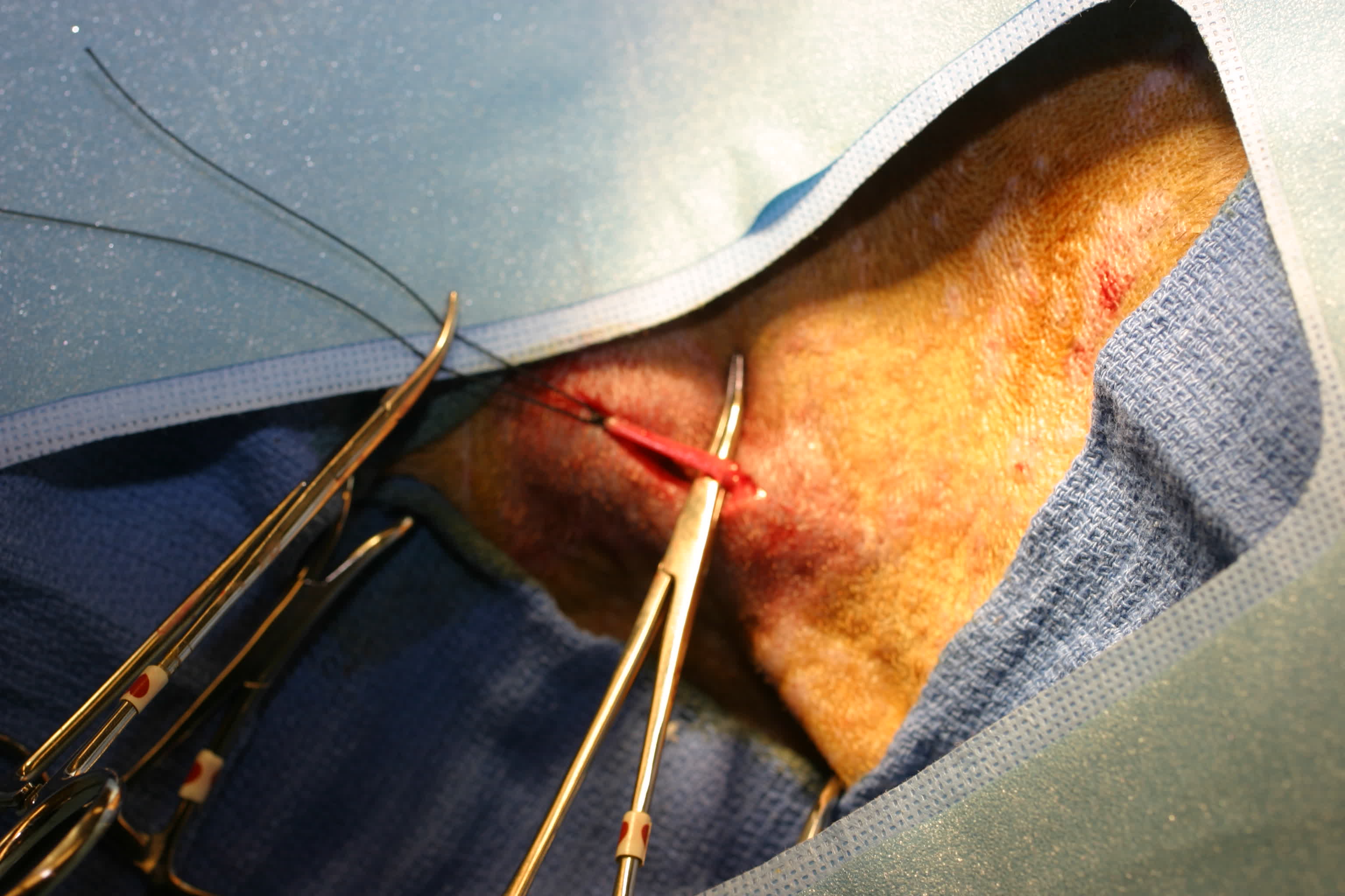 Pacemaker implantation image 3