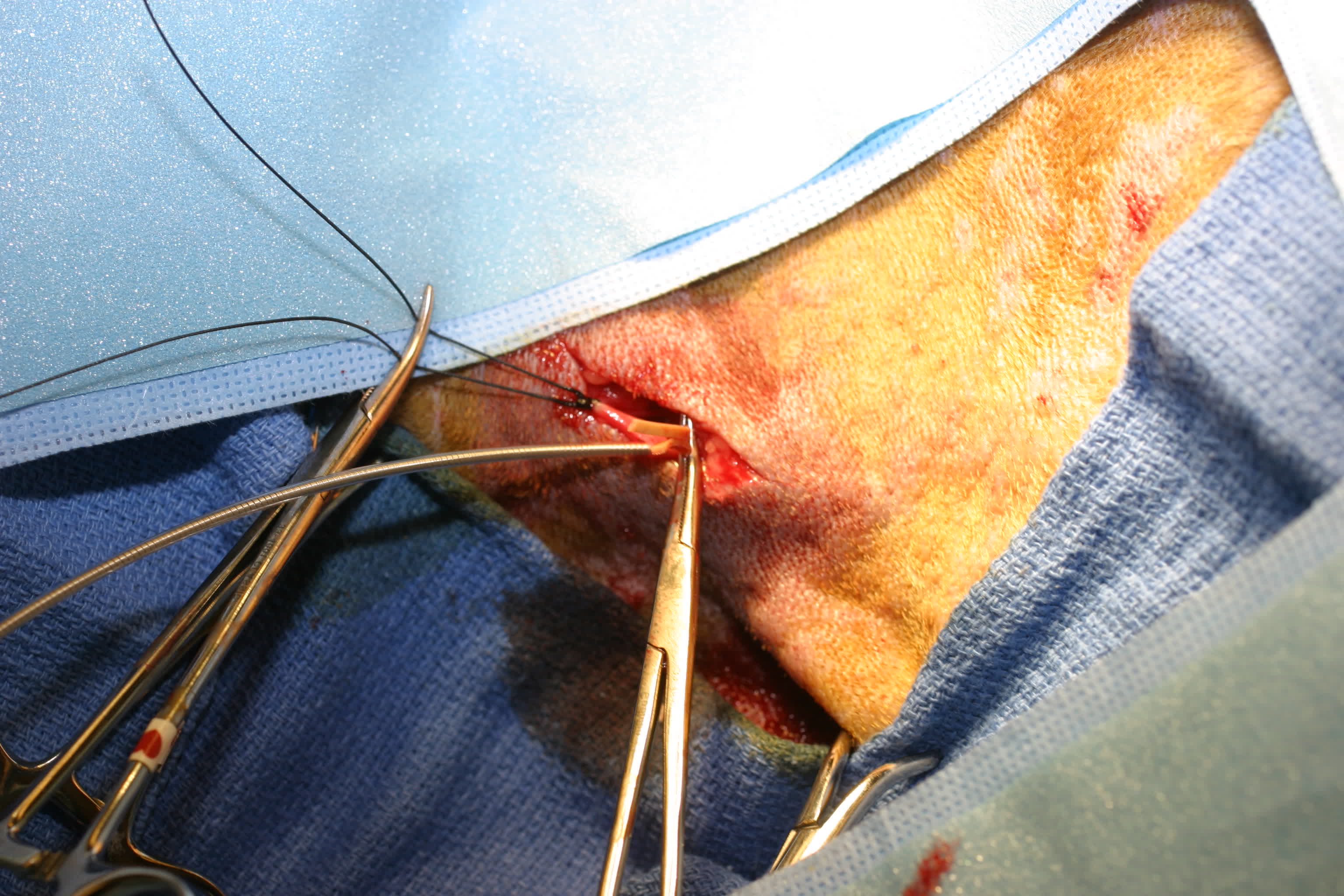 Pacemaker implantation image 4